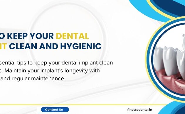 How to Keep Your Dental Implant Clean